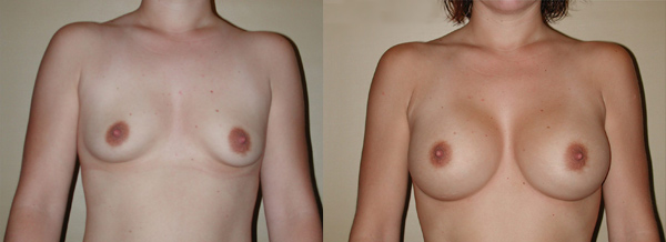Breast Augmentation in Mexico - Before and After