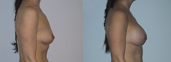 Breast Augmentation in Mexico - Before and After